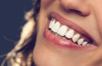 What You Can Get from Whitening Your Teeth Whitening Your Teeth